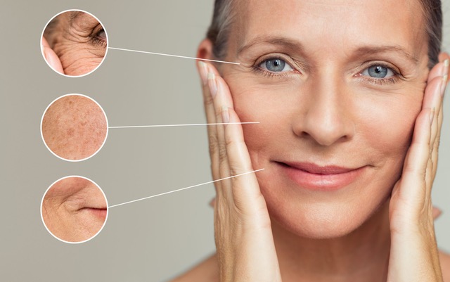 venus viva rf treatment
