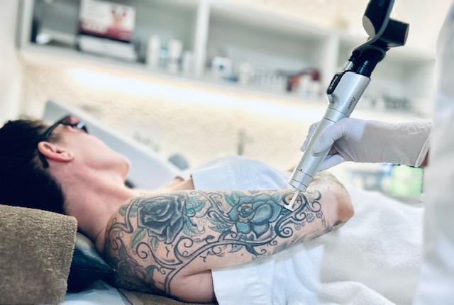 Tatoeage verwijderen-image